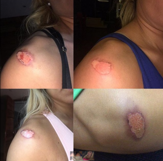 Aleida Núñez revela imágenes de la terrible quemadura que le provocó un vestuarista de televisión