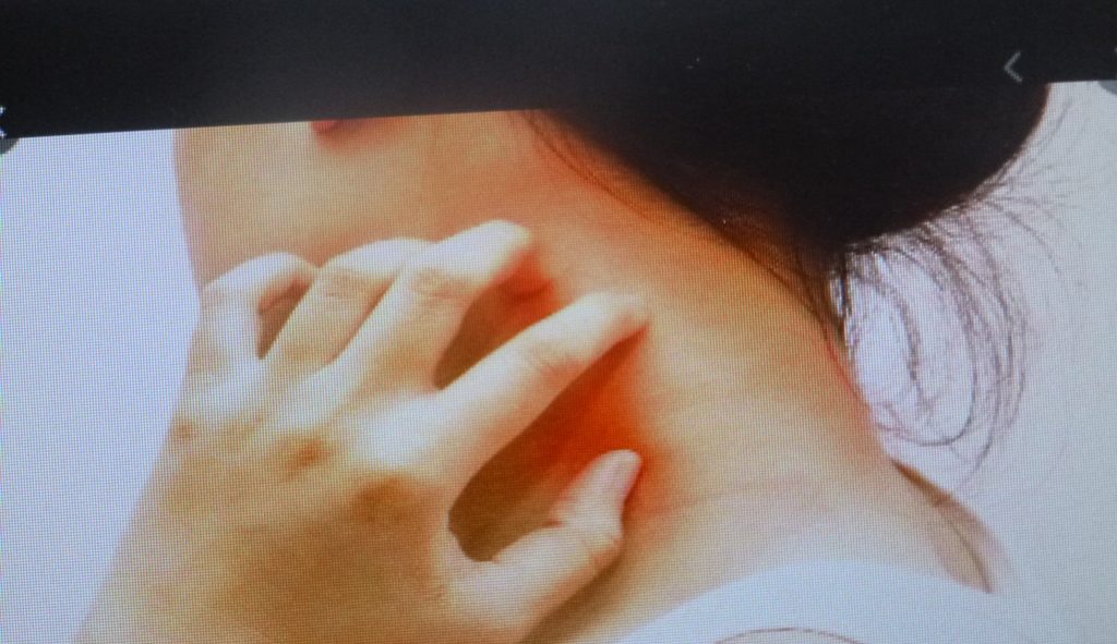 Alergias afectan hasta el 10 por ciento de la población en México