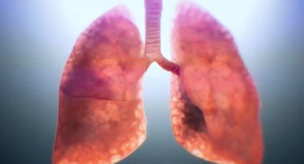 The Lancet: Turquía usa Favipiravir de Hisun para tratar COVID-19 con resultados notables