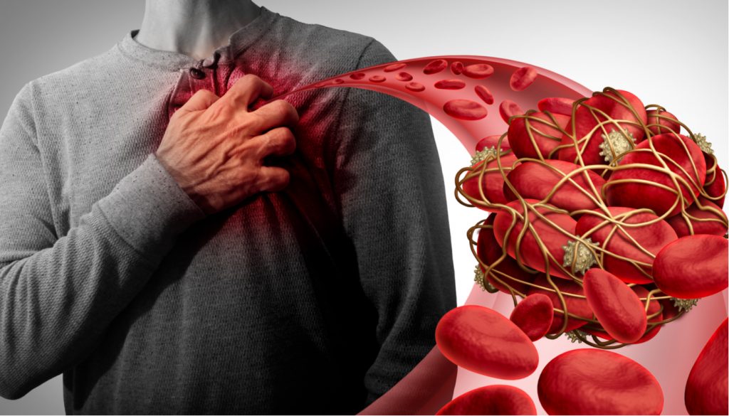 La campaña del Día mundial de la trombosis destaca la conexión potencialmente fatal entre la trombosis y la COVID-19