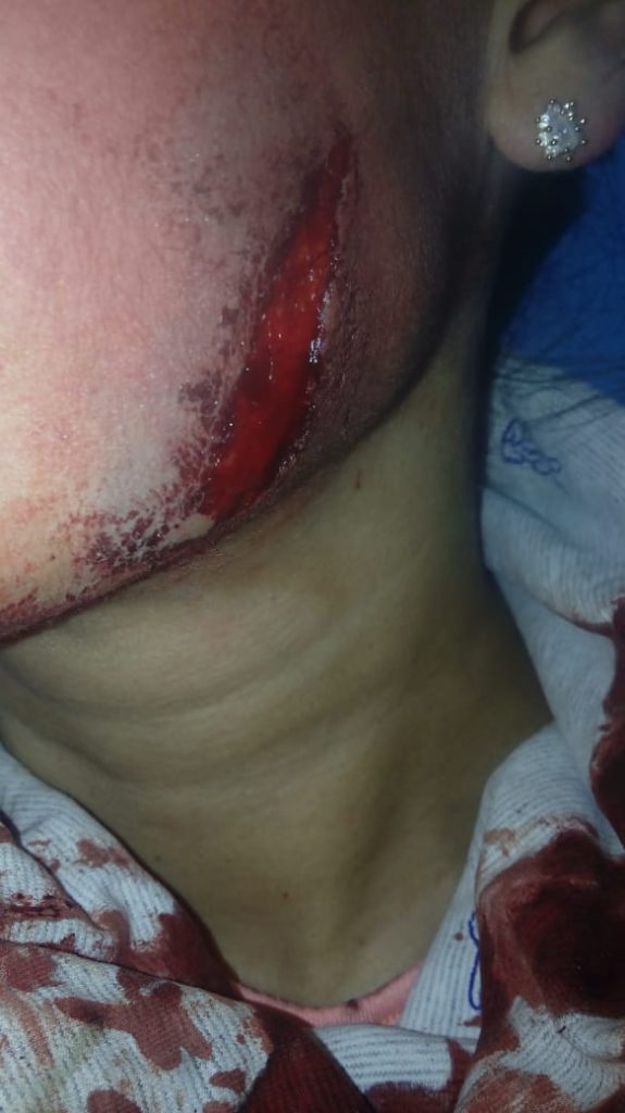 Sus vecinas le robaban el agua y luego le cortaron la cara por acusarlas