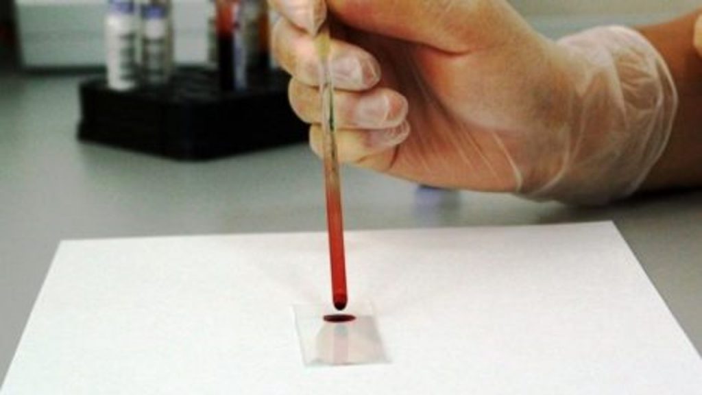 Biopsia líquida no invasiva para ayudar a que el diagnóstico de cáncer obtenga la certificación del marcado CE