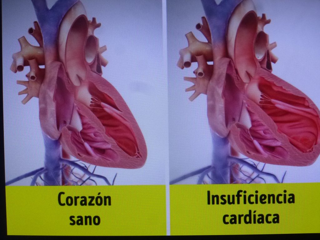 Coordinan esfuerzos gobierno y la medicina privada para combatir la insuficiencia cardiaca