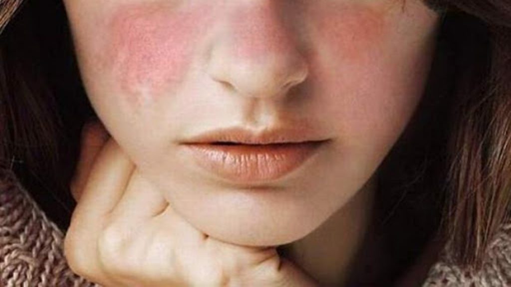 La encuesta global de personas con lupus de la Federación Mundial del Lupus revela que la mitad de los encuestados experimentó una disminución en el acceso a la atención médica durante la pandemia de COVID-19