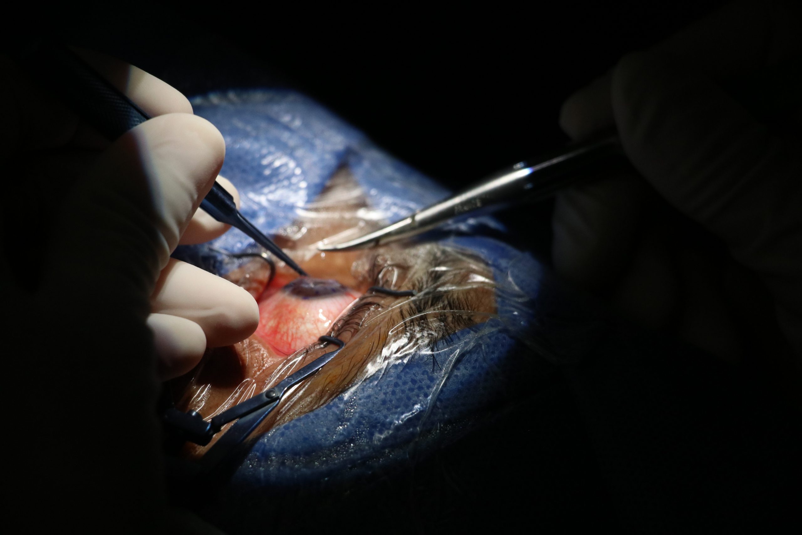 Realiza ISSSTEP primer trasplante de córnea del 2021