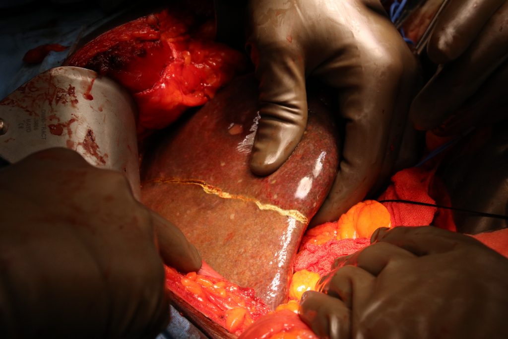 Impulsa ISSSTEP procedimientos de alta especialidad contra el cáncer