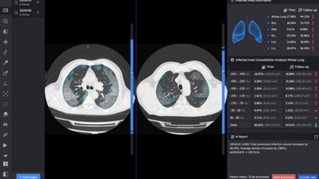 La IA de InferVision ayuda a la Comisión Europea a monitorear las variantes de la COVID-19