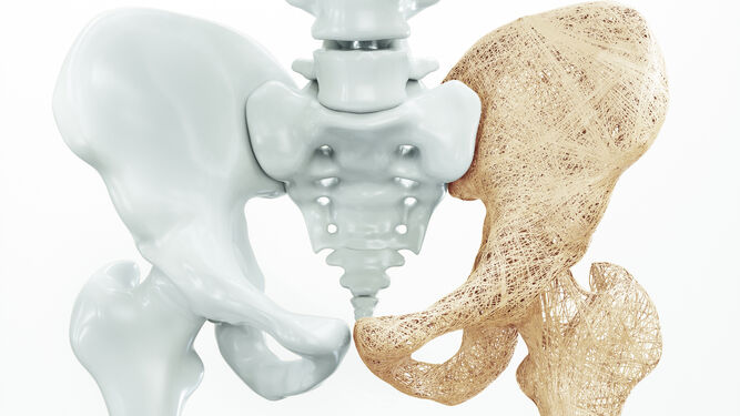 En el Día Mundial de la Osteoporosis, la International Osteoporosis Foundation (IOF) destaca el impacto negativo de la pandemia en el cuidado de la salud ósea