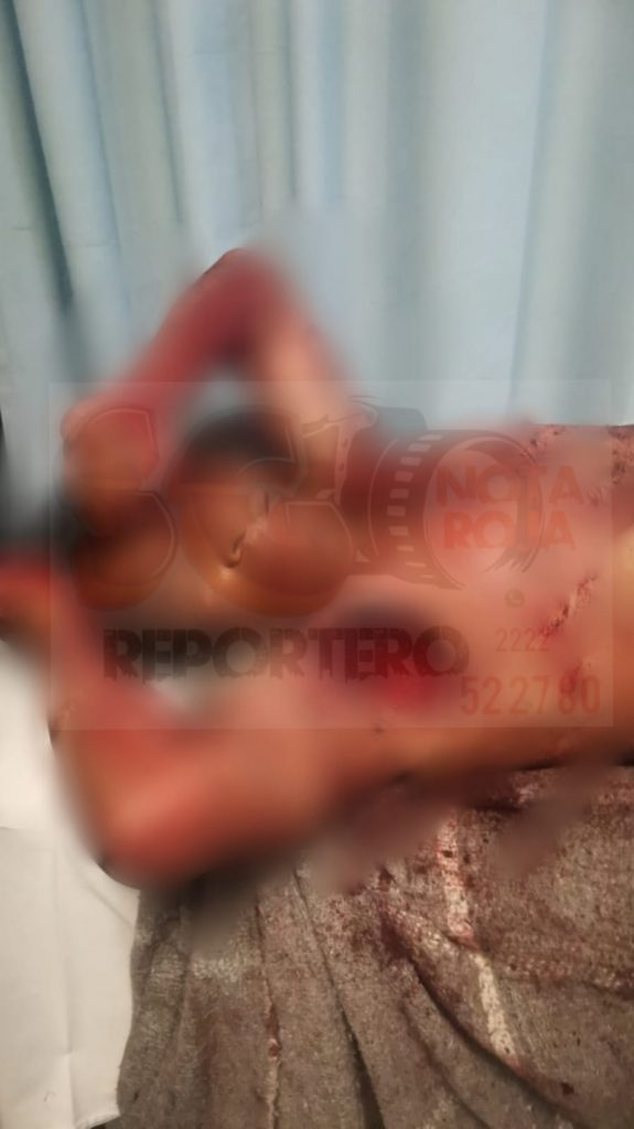 Muere hombre atacado por jauría en Teziutlán