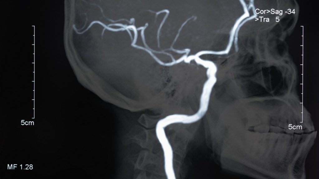 Conferencia de la Organización Europea del Ictus 2022: un nuevo estudio vincula las cepas de microbiota intestinal con accidentes cerebrovasculares más severos y una peor recuperación tras el ictus