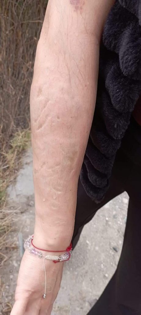 Una mujer fue atacada con ácido por dos hombres en la zona de Angelópolis