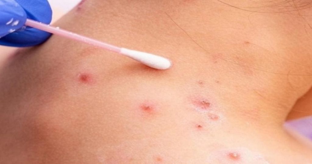 Brasil ya tiene 813 casos confirmados de viruela del mono