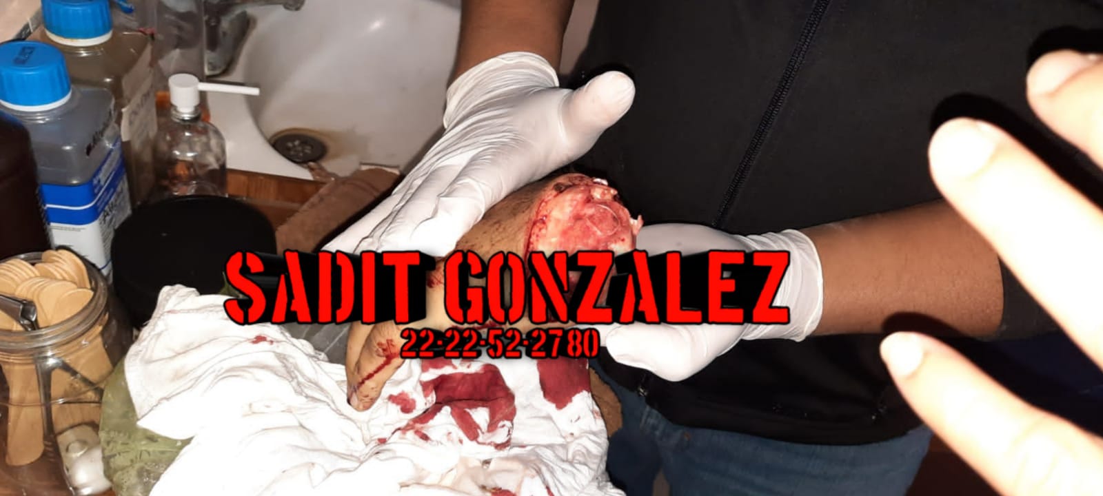 Policía pierde la mano por un machetazo de su padre en Hueytamalco