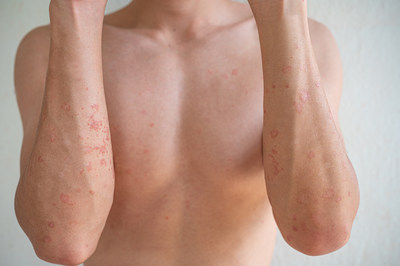 Padecimientos de la piel, la 4ª causa de enfermedades en el ser humano