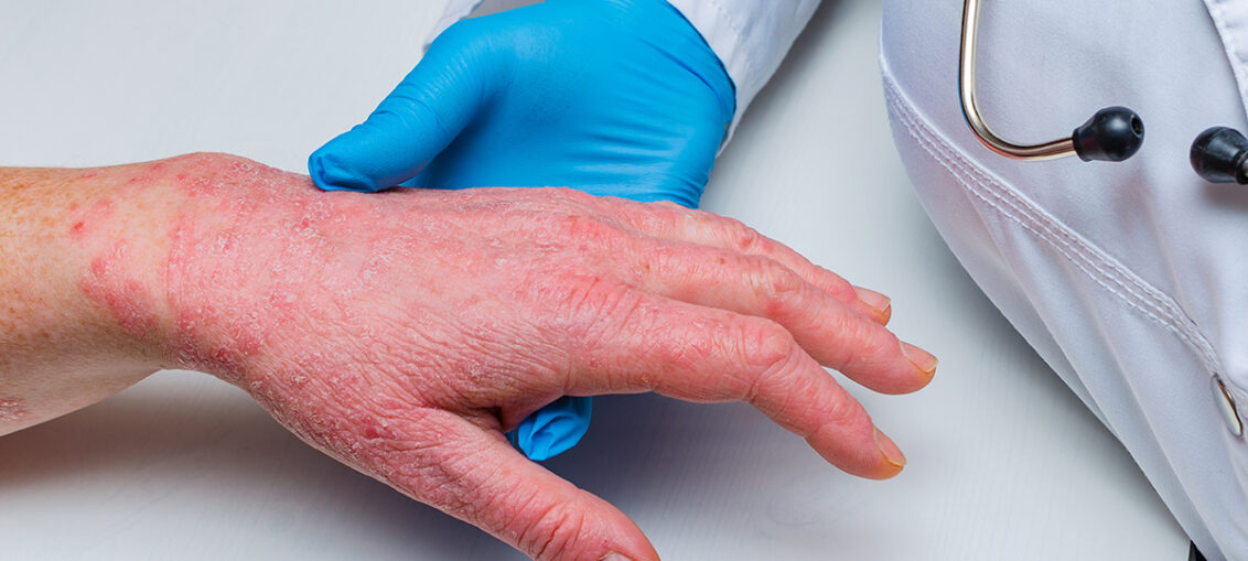 Estrés o eventos traumáticos, agudizan la dermatitis atópica hasta en un 70% de los pacientes