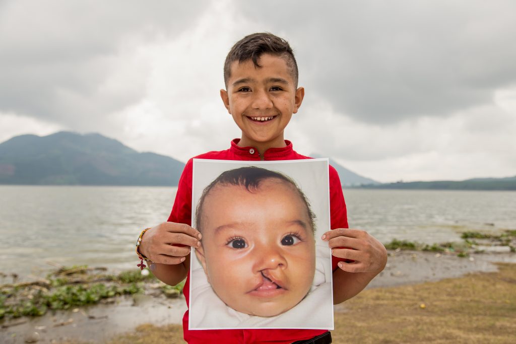 Smile Train comparte el primer estudio global que muestra las consecuencias de la desnutrición en niños y niñas que nacen con labio y paladar hendido