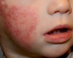 Una dermatitis atópica bien controlada es capaz de lograr una infancia plena y feliz.