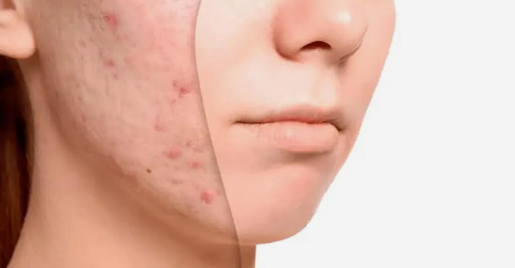 El acné afecta en todas las etapas de la vida; se debe acudir al dermatólogo para un tratamiento oportuno y evitar complicaciones