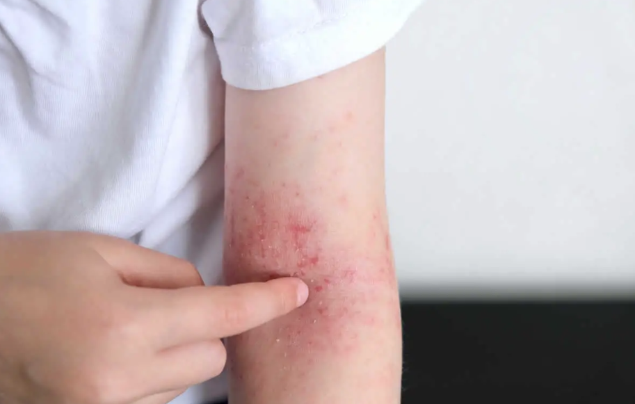 Dermatitis atópica, enfermedad de la piel que genera ausentismo escolar y laboral cuando no se diagnostica y se trata oportunamente
