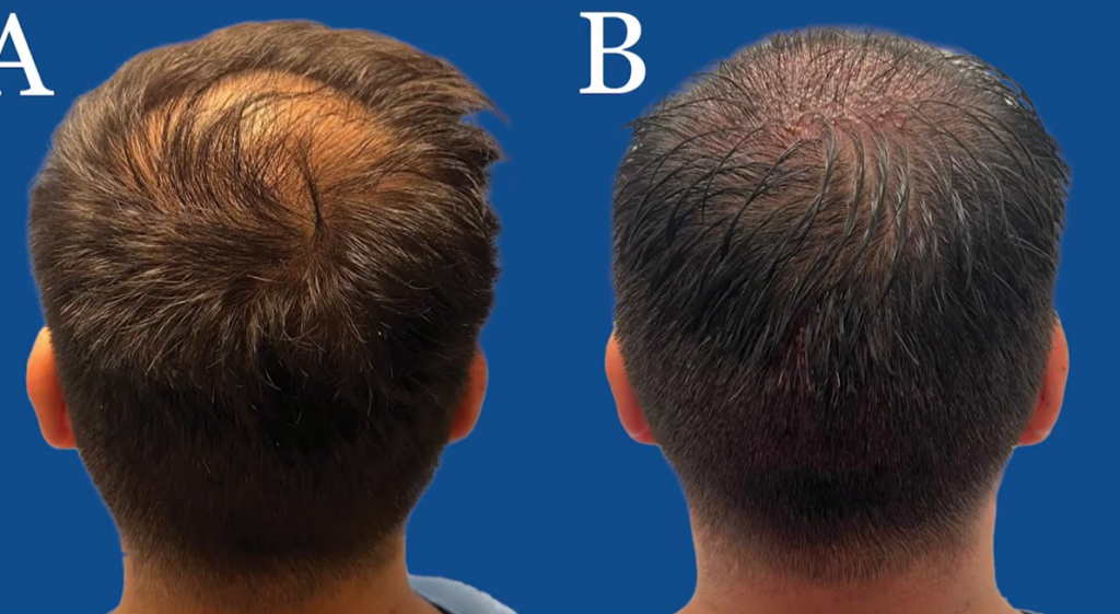 Un nuevo dispositivo facilita trasplantes exitosos de fue sin afeitada para cabello largo de manera práctica
