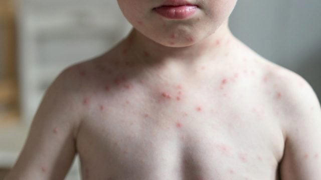 Más de la mitad de los países sufrirán alto riesgo de brotes de sarampión este año: OMS