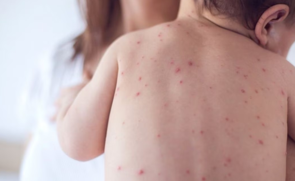 Emiten nueva alerta por sarampión; recomiendan aplicar vacuna a los menores para prevenir
