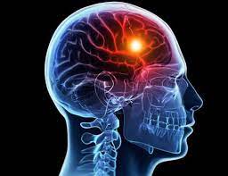 Infarto cerebral: 1.9 millones de neuronas destruidas por cada minuto sin recibir atención médica