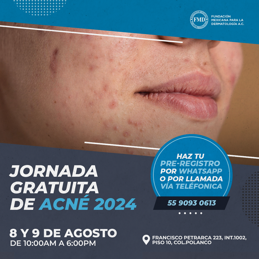 Realizará Fundación Mexicana para la Dermatología jornadas gratuitas de atención al paciente con acné en la Ciudad de México el 8 y 9 de agosto