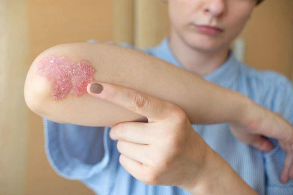 El Día Mundial de la Psoriasis se conmemora el 29 de octubre