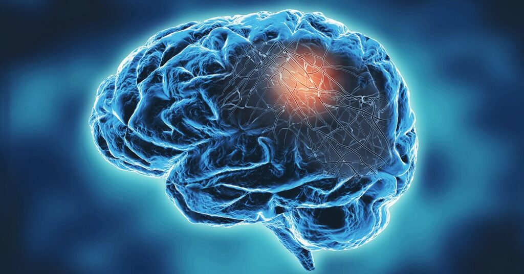 Diagnóstico oportuno y la salud del cuidador: Un doble reto en la atención de la enfermedad de Alzheimer